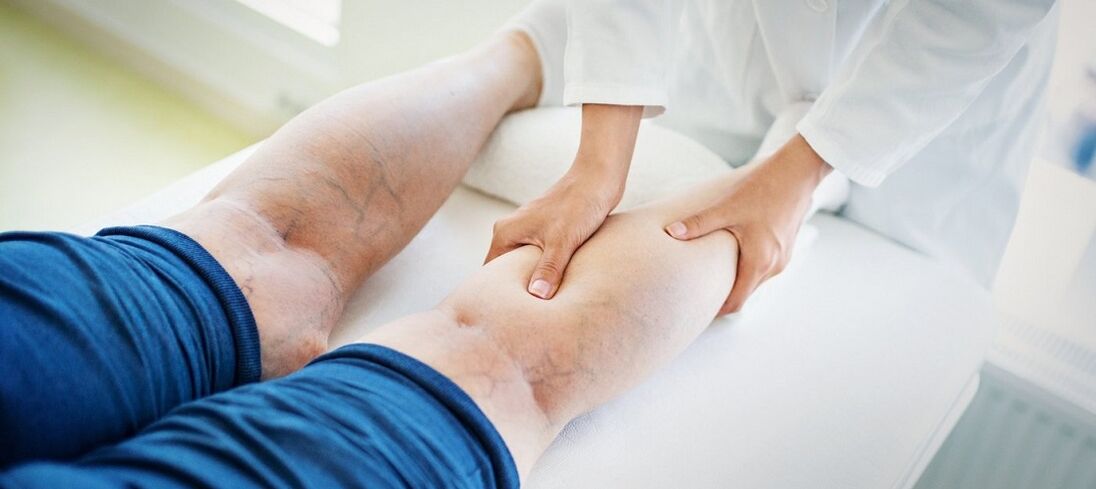 varices dans les jambes et leur traitement
