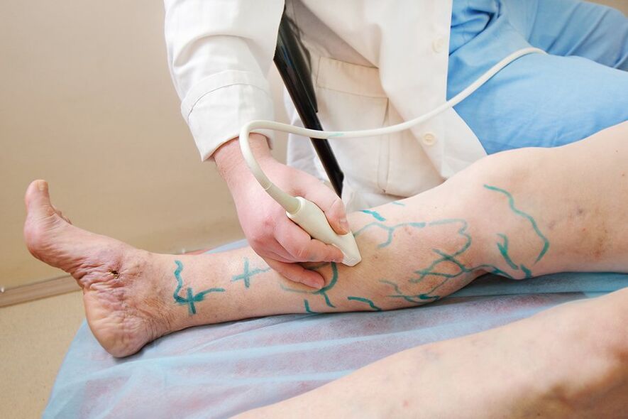Préparation au marquage de la miniphlébectomie dans les perforations du bas de la jambe, réalisation d'une échographie